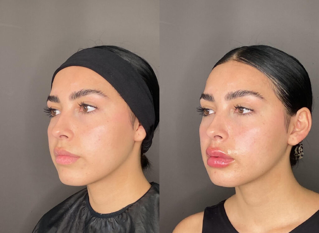 Relleno de labios con ácido Hialuronico